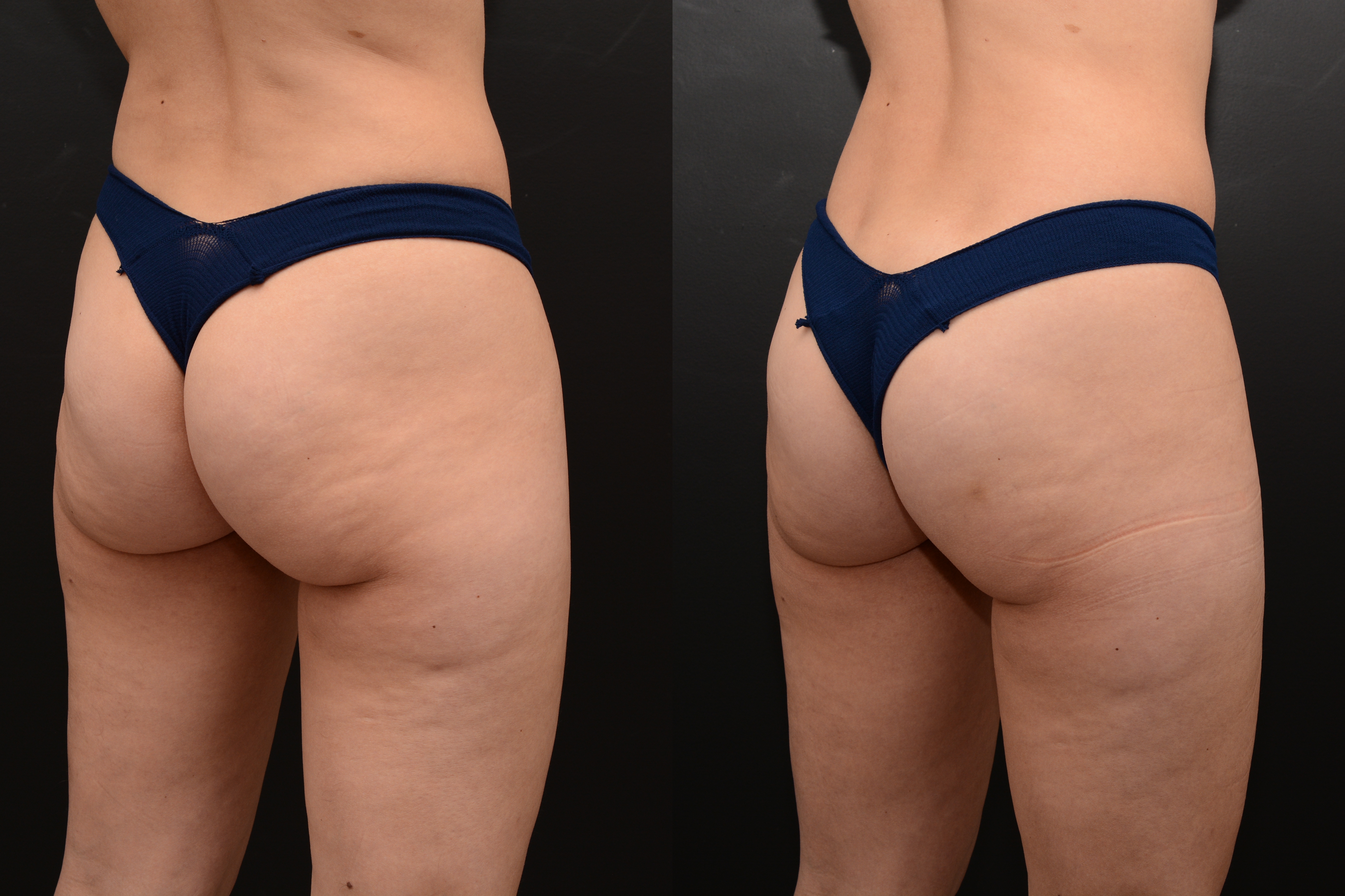 Emsculpt buttocks enhancement after 4 treatments - before and after